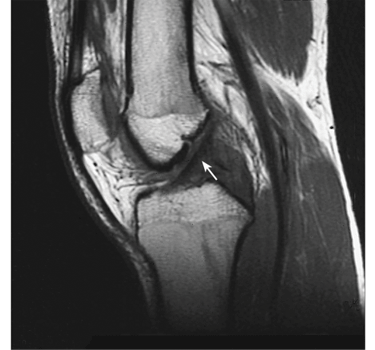 An MRI scan of a normal knee