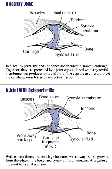 Osteoarthritis Joint Abnormalities